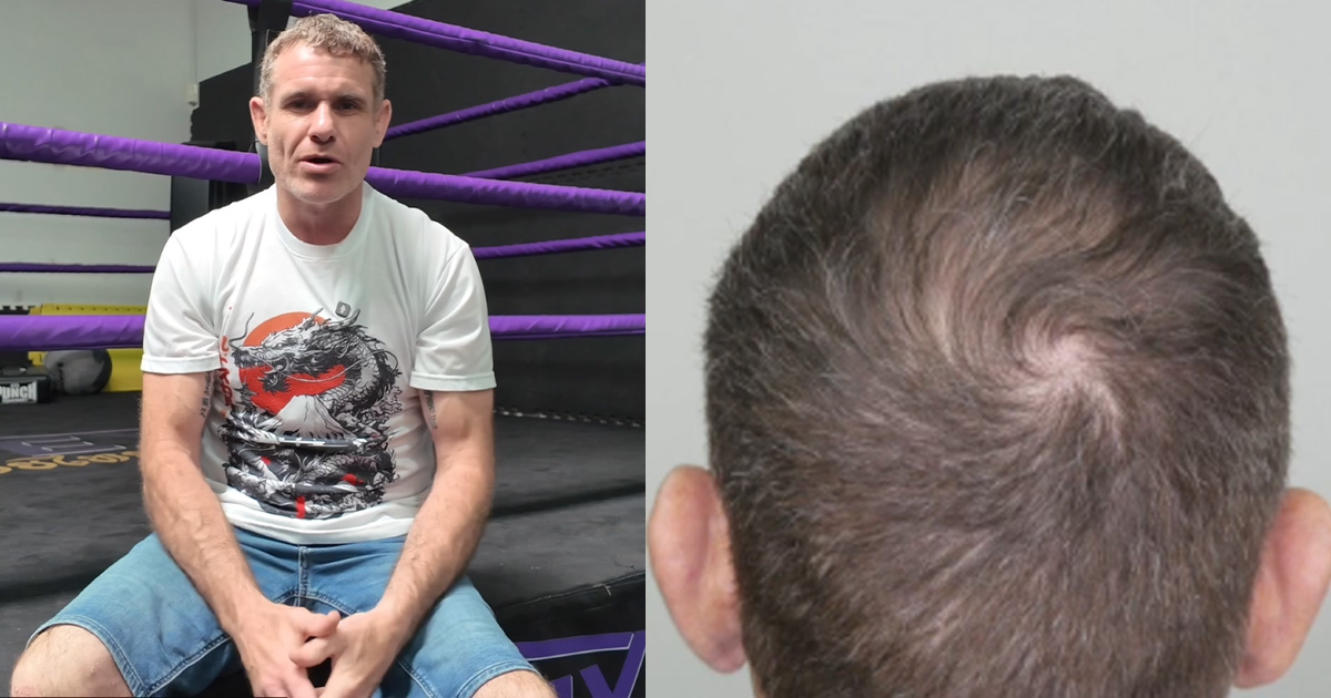 Regain Your Edge Why Investing in Your Hair is the Ultimate Power Move for Men in Their 40s